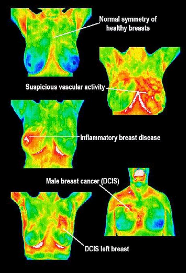 How Breast Thermography Works?