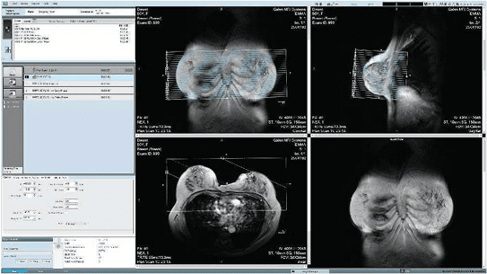 breast-scan-image